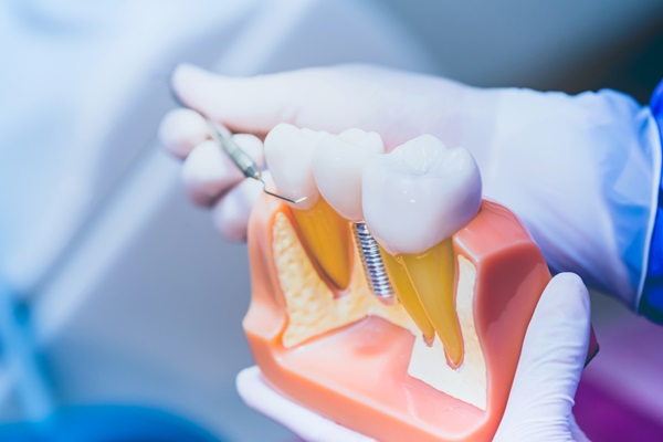 Questions To Ask A Dentist About Implant Crowns